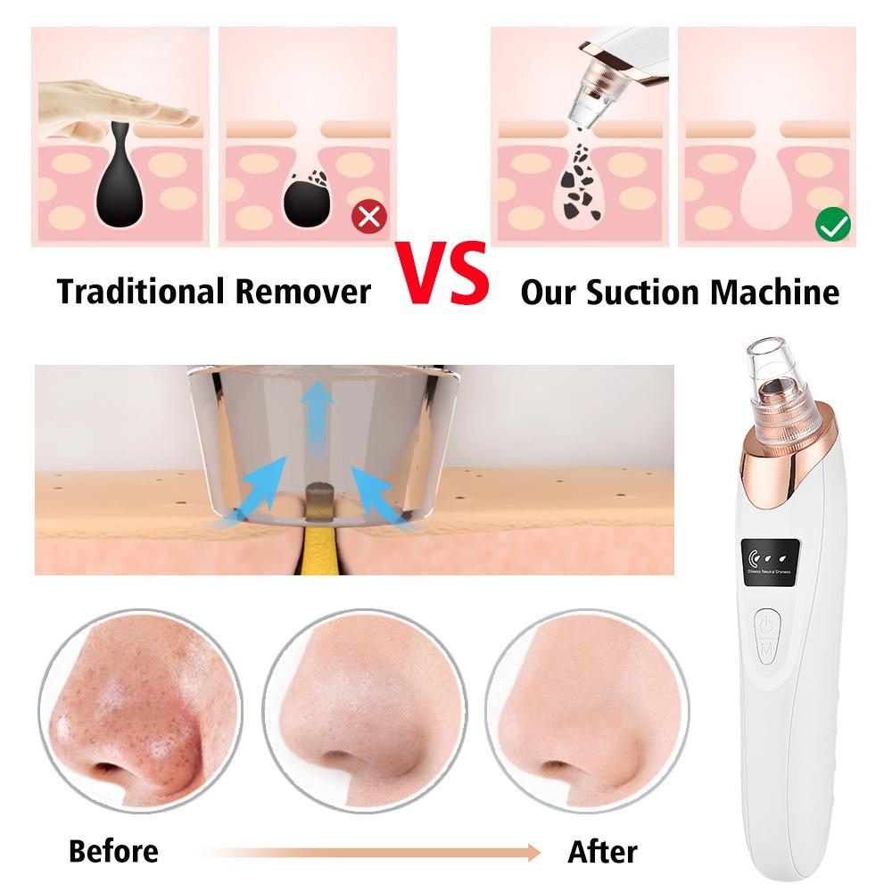 Blackhead Remover Vacuum – Electric Pore Cleanser with 5 Suction Levels