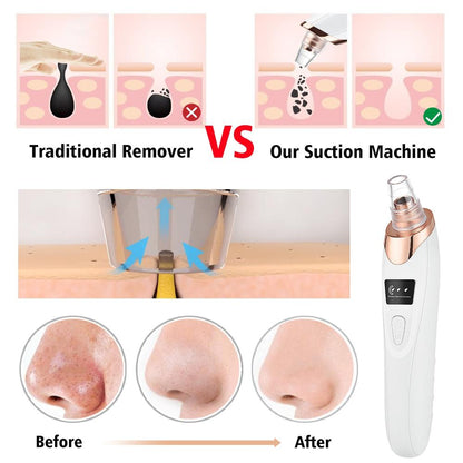 Blackhead Remover Vacuum – Electric Pore Cleanser with 5 Suction Levels