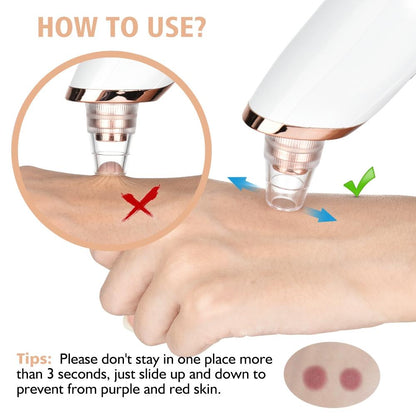 Blackhead Remover Vacuum – Electric Pore Cleanser with 5 Suction Levels